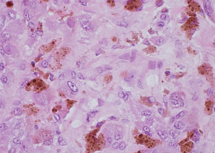 A 65-year-old man comes to the office due to 2 months of fatigue and persistent, nonproductive cough.  He has a history of coronary artery disease and myocardial infarction.  Three years ago, he underwent wide local excision of a melanoma on his posterior neck.  The patient has a 50-pack-year smoking history.  Vital signs are within normal limits.  Chest radiograph reveals multiple lung lesions and hilar lymphadenopathy.  Histopathology from one of the biopsied lung lesions is shown below after staining with hematoxylin and eosin.   These histopathologic findings are most consistent with which of the following diagnoses? A) Chronic systolic heart failure B) Emphysema C) Hodgkin lymphoma D) Metastatic melanoma E) Sarcoidosis F) Squamous cell lung cancer