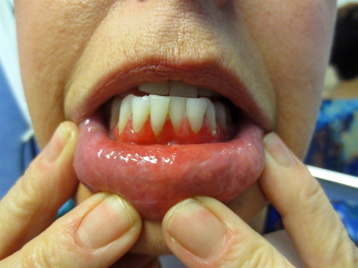 A 52-year-old woman comes to the office due to a 2-month history of oral lesions that cause pain with chewing and swallowing food.  The patient did not seek treatment because she thought the lesions would go away on their own, but they have persisted.  On examination, there are erosions of the buccal and gingival mucosa, as shown in the image below.  There are several flaccid bullae with erosions scattered over her trunk.  The blisters spread laterally with pressure, and traction on seemingly uninvolved skin produces blistering.  Autoantibodies directed against which of the following structures are most likely responsible for this process?   A) Basement membrane B) Connexin proteins C) Desmosomes D) Hemidesmosomes E) Tissue transglutaminase