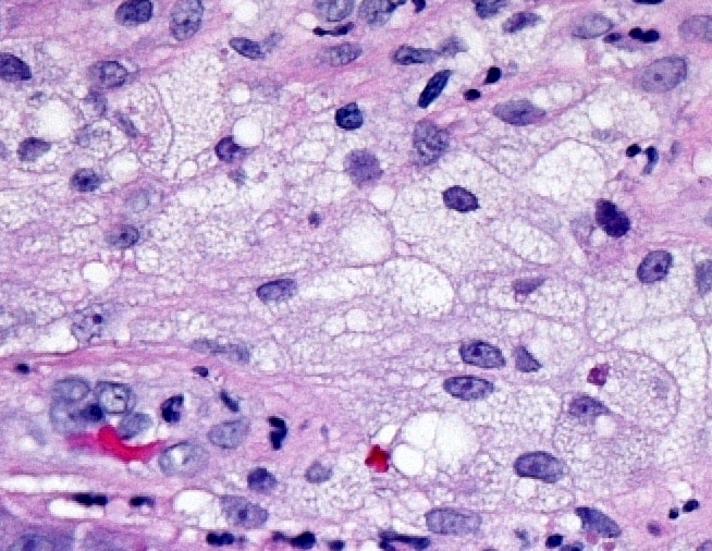 A skin lesion on the upper eyelid of a 46-year-old woman is biopsied.  Light microscopy of the tissue specimen is shown in the image below.   This lesion is most likely to be associated with which of the following conditions? A) Ankylosing spondylitis B) Hemochromatosis C) Hyperthyroidism D) Peptic ulcer disease E) Polycystic kidney disease F) Primary biliary cholangitis