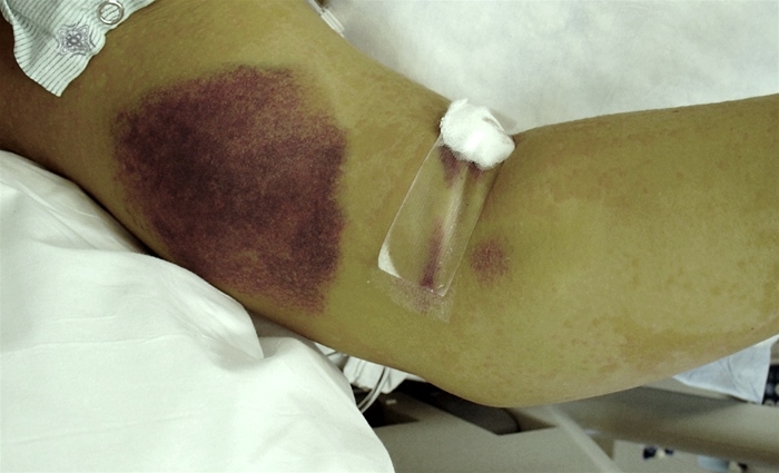 A 32-year-old woman is brought to the emergency department due to  bruising.   She has a chronic mental disability and lives in a group home.  Care staff members accompanying the patient report that she fell 3 days ago but has not mentioned any pain.  No signs of injury were noted until a large area of discoloration was seen at the upper arm during bathing.  Past medical history is unremarkable, and the patient takes no medications.  Vital signs are normal.  Skin examination findings are shown in the image below.  There is no associated warmth, and the patient shows no signs of discomfort during palpation of the affected area.   Which of the following terms best describes this abnormality? A) Angioma B) Ecchymosis C) Lentigo D) Petechia E) Purpura F) Telangiectasia
