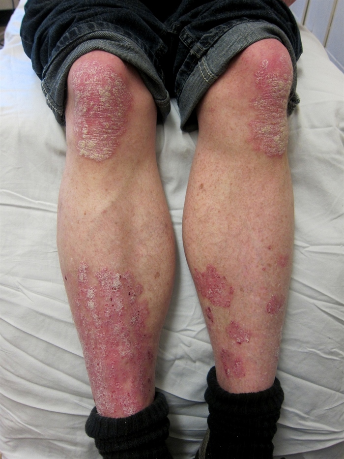 A 34-year-old man comes to the office due to a persistent skin rash.  He has a 6-month history of a scaly rash involving the upper and lower extremities that is associated with mild pruritus.  The patient has attempted treatment with topical antihistamines and emollients without relief.  Medical history is notable for childhood asthma and orolabial herpes simplex virus infection.  He does not use tobacco or alcohol and works as a sales associate for a home improvement store.  On examination, the patient has skin lesions as shown in the image below.   This patient's disorder is most likely associated with which of the following extradermal complications? A) Chronic glomerulonephritis B) Deforming joint disease C) Medullary thyroid cancer D) Peripheral neuropathy E) Pulmonary fibrosis