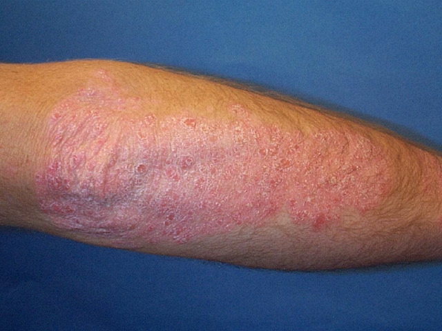 A 35-year-old man comes to the office for evaluation of a rash on his elbows.  The patient has had this rash intermittently for several months, but lately, it has become more persistent and bothersome.  He has had mild associated itching but no pain and has tried a topical moisturizing lotion without relief.  The patient installs tile floors for a residential construction company.  He has no chronic medical conditions and takes no regular medications.  The patient does not use tobacco, alcohol, or illicit drugs.  Vitals signs are within normal limits.  The rash on his elbow is shown below, and a similar rash is present on the other elbow.   Which of the following histologic changes would be most likely if this patient's skin lesion were biopsied? A) Epidermal hyperplasia B) Granulomatous inflammation C) Intense eosinophilic infiltration D) Squamous cell dysplasia E) Thinning of the epidermis