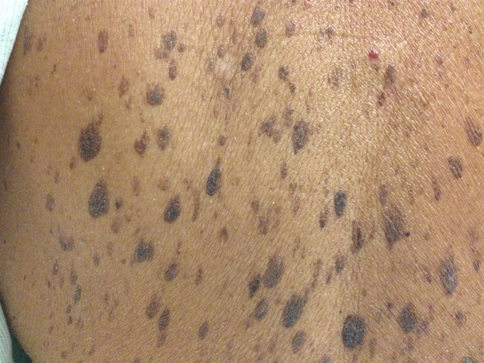 A 65-year-old man comes to the office due to skin lesions on his back.  He first noted the spots 5 years ago and says they are becoming more numerous.  The lesions are occasionally pruritic but are otherwise asymptomatic.  The patient did not come for evaluation previously because he  did not care about them,  but made an appointment now at his wife's insistence.  Medical history is notable for hypertension, hyperlipidemia, and type 2 diabetes mellitus.  On examination, there are numerous pigmented plaques, as shown in the image below.   Which of the following is the most likely diagnosis? A) Acanthosis nigricans B) Actinic keratosis C) Lichen planus D) Malignant melanoma E) Psoriasis F) Seborrheic keratosis