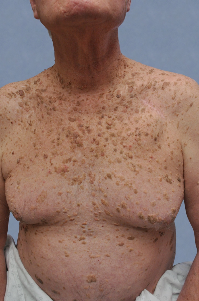 A 65-year-old man comes to the office due to fatigue, decreased appetite, and weight loss.  He has lost 5.4 kg (12 lb)  over the last 3 months and eats only small portions of food because he feels full soon after he begins eating.  The patient smokes a pack of cigarettes per day and drinks alcohol socially.  Blood pressure is 152/90 mm Hg and pulse is 90/min.  Physical examination shows a firm, 3-cm lymph node above the left clavicle.  There are also numerous skin lesions on his trunk, as shown below, which the patient notes have developed since the onset of his other symptoms.   This patient's skin lesions most likely represent which of the following conditions? A) Acanthosis nigricans B) Malignant melanoma C) Neurofibromatosis D) Psoriasis E) Seborrheic keratosis F) Tuberous sclerosis