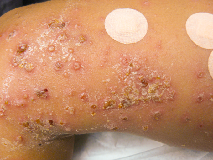 An 8-year-old boy is brought to the office due to a lower extremity skin rash for the past 3 days.  The rash began as tender papules that quickly progressed to form vesicles and flaccid bullae that rupture easily.  The patient has no mucosal lesions or other rashes and has never had similar symptoms before.  He is up to date with recommended vaccinations and takes no medications.  Skin examination findings are shown below.   Which of the following is the most likely cause of this patient's skin findings? A) Autoantibodies targeted against hemidesmosomes B) Autoantibody-mediated epidermal cell separation C) Bacterial toxin-induced desmoglein 1 cleavage D) Defective epidermal barrier and T-cell dysregulation E) Inflammatory response to viral lytic infection