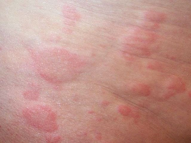 A 38-year-old woman comes to the urgent care clinic with a 2-day history of sore throat.  It is associated with fever and cervical lymphadenopathy, but not rhinorrhea, sneezing, or coughing.  On examination, erythema and edema involving the posterior pharynx and a purulent tonsillar exudate are present.  Rapid bedside streptococcal antigen testing is positive, and the patient is started on oral penicillin V.  She returns the following day with a pruritic skin rash that came on suddenly after starting the antibiotic.  The skin lesions observed on physical examination are shown in the image below.   What is the most likely finding on biopsy of these lesions? A) Acantholysis B) Acanthosis C) Dermal edema D) Dyskeratosis E) Epidermal spongiosis