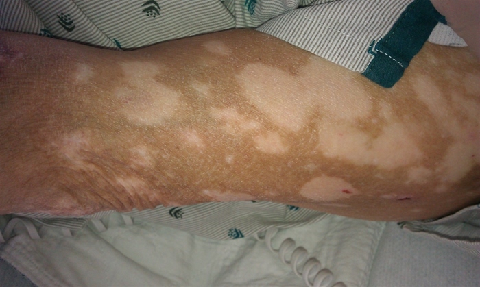 A 46-year-old man comes to the office with the skin lesions shown in the photograph below.  The patient first noticed the lesions a week ago after he returned from a trip to Hawaii.  He has not had any other significant rashes or skin lesions but does have a history of autoimmune thyroiditis.   Which of the following would most likely be seen on histopathologic examination of this patient's lesions? A) Absence of melanocytes in the epidermis B) Linear pattern of melanocyte proliferation C) Melanosome aggregates within the cytoplasm of melanocytes D) Normal melanocytes with diminished pigment transfer to keratinocytes E) Poor melanin formation in melanocytes