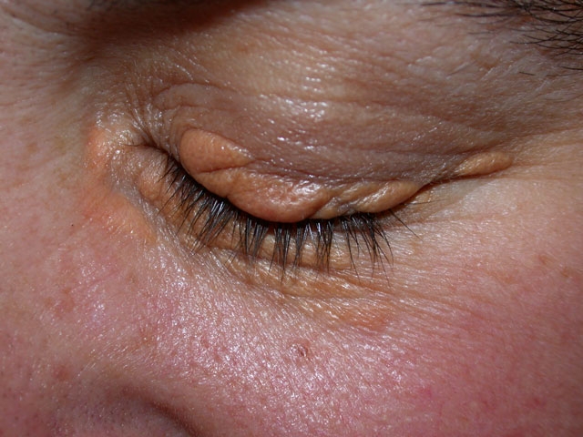 A 42-year-old woman comes to the physician for a routine check-up.  She has no current complaints and no significant past medical history.  On physical examination, the physician notes lesions on her eyelids that are pictured below.   Which of the following is the best next step in the management of this patient? A) ECG and serum cardiac enzymes B) Serum lipids and blood glucose level C) Liver function tests and abdominal ultrasonography D) Complete blood count and stool guaiac test E) Slit lamp exam and ophthalmoscopy F) Lesion biopsy and surgeon referral