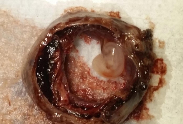 A 38-year-old woman comes to the emergency department for lower abdominal pain.  The patient has had some mild, cramping abdominal pain for the past few days, but today it became constant.  She has also had intermittent vaginal bleeding.  The patient has a history of irregular menses, and her last menstrual period was 8 weeks ago.  Physical examination shows a left adnexal mass.  The patient undergoes surgery and the resected specimen is shown in the image below:   Which of the following risk factors is most strongly associated with this patient's condition? A) Family history of ovarian cancer B) Müllerian anomaly C) Prior pelvic surgery D) Progestin-only oral contraceptive use E) Recent anticoagulant use