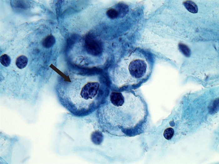 A 21-year-old woman, gravida 0, comes to the office due to postcoital bleeding.  She has been sexually active with her male partner for 6 months.  The patient has been taking birth control pills since age 15, when she first became sexually active.  The patient and her partner do not use condoms and have never been diagnosed with a sexually transmitted infection.  The patient smokes a pack of cigarettes per day.  Bimanual examination reveals a small mobile uterus and no cervical motion tenderness.  Speculum examination shows a well-estrogenized vagina without lesions.  The cervix has an area of erythema surrounding the external os and scant clear discharge.  She has her first Papanicolaou smear, and the cytological finding is shown in the image below.   Which of the following best describes the finding shown on this patient's slide? A) Actinomyces-like organisms B) Candida albicans C) Clue cell D) Endometrial cell E) Glandular cell F) Koilocyte G) Parabasal cell