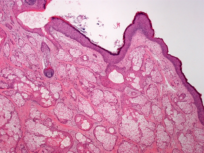 A 26-year-old woman is being evaluated for lower abdominal discomfort.  Medical history is significant for mild intermittent asthma and migraines without aura.  She has never been pregnant.  The patient is sexually active with her husband and they use condoms for contraception.  She drinks alcohol socially and does not use tobacco or illicit drugs.  Her mother was diagnosed with breast cancer at age 52 and her grandfather died of colon cancer at age 77.  BMI is 30 kg/m<sup>2</sup>.  Ultrasound of the abdomen reveals a right-sided adnexal mass that is subsequently removed with laparoscopic surgery.  Histologic findings are shown in the image below:   Which of the following is the most likely diagnosis? A) Ectopic pregnancy B) Endometriosis C) High-grade serous ovarian carcinoma D) Mature teratoma E) Polycystic ovary syndrome