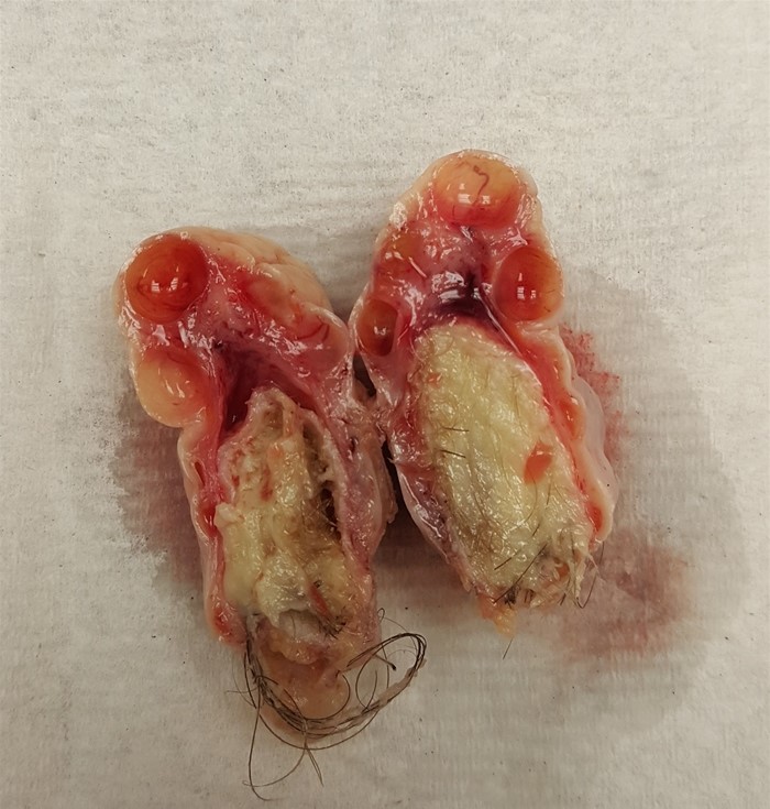 A 37-year-old woman comes to the emergency department due to sudden-onset nausea and severe right lower quadrant pain.  The pain developed an hour ago after exercise and has become increasingly severe.  The patient has no chronic medical conditions and has had no prior surgeries.  She does not use contraception, and her last menstrual period was 3 weeks ago.  Blood pressure is 136/94 mm Hg and pulse is 104/min.  The abdomen is tender to palpation over the right lower quadrant.  Pelvic ultrasound shows a right ovarian mass with no blood flow to the ovary.  The specimen obtained from diagnostic laparoscopy and right oophorectomy is shown in the image below:   Which of the following is the most likely diagnosis? A) Ectopic pregnancy B) Endometrioma C) Mature cystic teratoma D) Mucinous cystadenoma E) Ovarian fibroma F) Yolk sac tumor