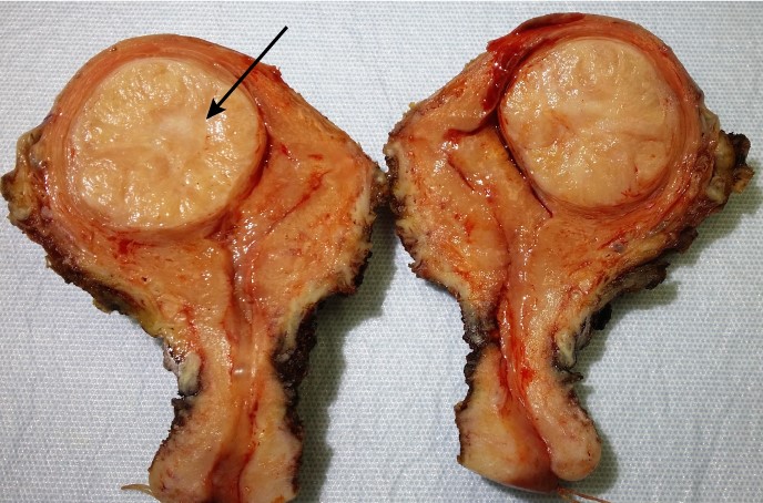 A 48-year-old woman comes to the office due to heavy menstrual bleeding for the last several months.  The patient has monthly menses with 5-6 days of heavy bleeding and passage of large blood clots and increased abdominal cramping.  She has no significant medical history and has had 2 vaginal deliveries.  Her family history is significant for endometrial cancer in her mother.  BMI is 24 kg/m<sup>2</sup>.  Vital signs are normal.  Pelvic ultrasound shows a uterine mass.  The patient undergoes a total abdominal hysterectomy; gross examination of the uterus is shown below:   The abnormal region indicated by the arrow is most likely to display which of the following microscopic findings? A) Dysplastic squamocolumnar cells with areas of atypia B) Ectopic endometrial glands and hemosiderin-laden macrophages C) Hyperplastic proliferation of irregular endometrial glands D) Infiltration of the stroma by high-grade serous carcinoma E) Monoclonal proliferation of myocytes and fibroblasts