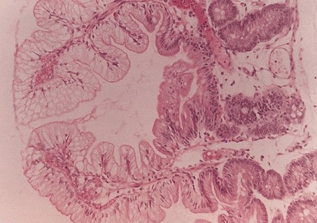 A 5-month-old boy is being evaluated for poor weight gain since birth.  He is noted to have bulky and greasy stools.  A jejunal biopsy shows the findings seen in the slide below.   Which of the following is the most likely diagnosis? A) Abetalipoproteinemia B) Celiac disease C) Chronic pancreatitis D) Crohn disease E) Lactase deficiency F) Whipple disease G) Zollinger-Ellison syndrome
