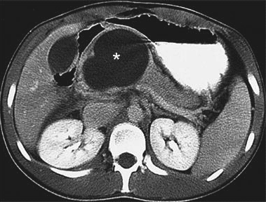A 48-year-old male is admitted to the hospital with severe epigastric abdominal pain and vomiting after an episode of binge-drinking.  Four weeks later, he is found to have a palpable upper abdominal mass and a cystic lesion is visualized on computed tomography scanning (see image below, asterisk marks the lesion) .   The inner walls of the lesion are most likely lined with: A) Glycogen-rich cuboidal epithelium B) Columnar mucinous epithelium C) Atypical cells forming papillary projections D) Fibrous and granulation tissue E) Endothelial cells