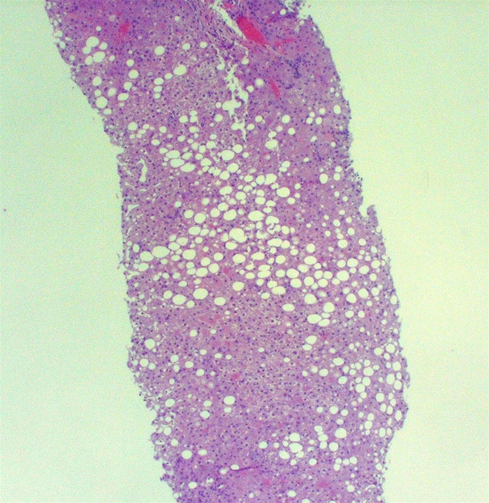A 32-year-old man with mild abdominal discomfort and anorexia admits consuming large amounts of alcohol recently.  He undergoes a liver biopsy, which shows the light microscopy findings seen in the image below.   Which of the following is the most likely cause of this patient's condition? A) Decreased triglyceride synthesis B) Decreased free fatty acid oxidation C) Increased phospholipid catabolism D) Enhanced lipoprotein assembly E) Increased gluconeogenesis F) Increased glucose uptake into cells