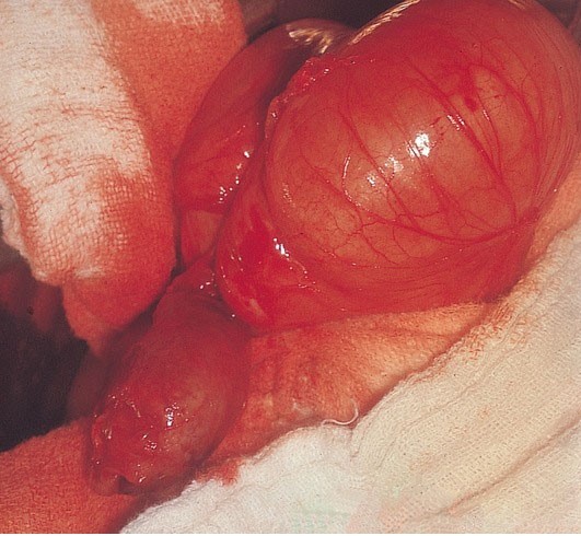 A 22-year-old Caucasian male presents to the ER with abdominal pain that started around his bellybutton, then moved to the right lower abdominal quadrant.  After initial evaluation, laparotomy is performed, which reveals the following findings (see the slide below) .   Which of the following most likely initiated this patient's condition? A) Bacterial infection B) Peptic ulceration C) Lumen obstruction D) Venous thrombosis E) Arterial spasm