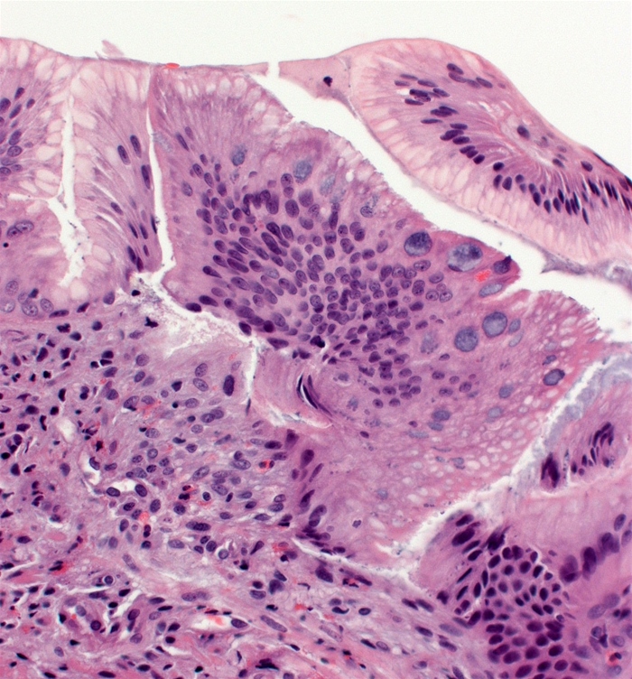 A 49-year-old man comes to the office for evaluation of a dry cough that occurs mainly at night.  His symptoms have been present on and off for several years, but he has not been previously evaluated.  The patient also reports a frequent sore throat and occasional epigastric discomfort.  He has tried a variety of antihistamines and over-the-counter cough medications without relief.  Past medical history is notable for obesity and diet-controlled type 2 diabetes mellitus.  He does not smoke or drink alcohol.  Cardiopulmonary and abdominal examinations are unremarkable.  Chest x-ray reveals no abnormalities, and pulmonary function testing is normal.  The patient undergoes upper gastrointestinal endoscopy with mucosal biopsies.  Microscopic findings on lower esophageal biopsy are shown in the image below.   This patient is at highest risk of which of the following complications? A) Achalasia B) Adenocarcinoma C) Crohn disease D) Squamous cell carcinoma E) Variceal bleeding