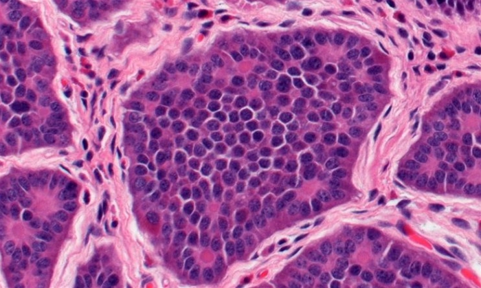 A 38-year-old woman comes to the hospital with 4 hours of abdominal pain, nausea, and vomiting.  Her pain started in the periumbilical area and is now localized to the right lower quadrant.  Temperature is 38.3 C (101 F) .  On examination, the patient has right lower quadrant tenderness with guarding.  An appendectomy is performed, and light microscopy of the appendix shows infiltrating neutrophils in the muscularis propria, consistent with the diagnosis of acute appendicitis.  Further evaluation reveals abnormal islands of small cells, as shown in the image below.   These cells are most likely derived from which of the following sources? A) Connective tissue B) Hematopoietic cells C) Intestinal mucus-secreting cells D) Neuroendocrine cells E) Smooth muscle cells F) Vascular endothelium
