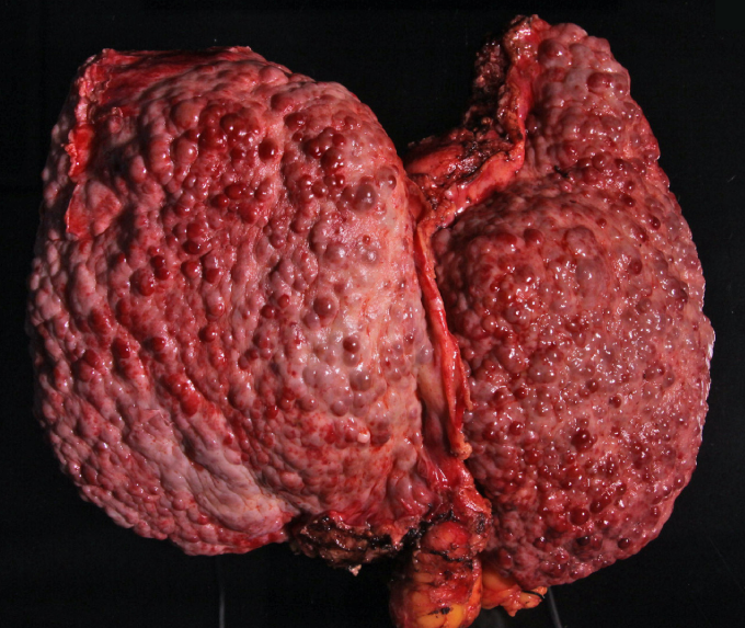 A 54-year-old man dies from profuse upper gastrointestinal hemorrhage.  An autopsy is performed; gross examination of his liver is shown in the image below.   This patient's liver findings most likely resulted from which of the following processes? A) Dilation of sinusoids and perivenular hemorrhage B) Fibrosis and nodular parenchymal regeneration C) Granulomatous destruction of bile ducts D) Intrahepatic hydatid cysts with surrounding fibrous reaction E) Pigment accumulation within hepatocytes