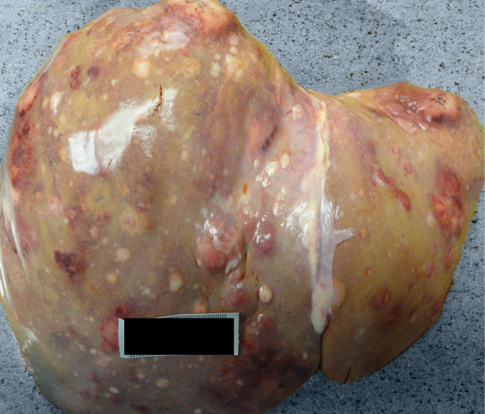 A 65-year-old woman has had several months of progressive fatigue, diminished appetite, and unintentional weight loss.  The patient has no chronic medical conditions.  She has not received medical care in many years and has not had recommended cancer screening.  The patient suddenly dies while undergoing evaluation.  Autopsy reveals abnormal liver findings, as shown in the exhibit below.   Microscopic evaluation of the lesions reveals neoplastic cells.  Which of the following is the most likely cause of this patient's liver lesions? A) Lymphatic spread of a malignancy B) Malignancy metastasizing via the hepatic veins C) Malignancy spreading through the portal circulation D) Primary neoplastic transformation of hepatocytes E) Transcoelomic spread of a malignancy