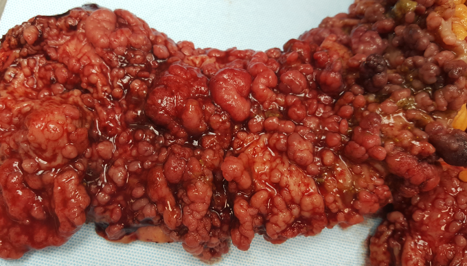 A 26-year-old woman is evaluated for intermittent abdominal discomfort, diarrhea, and melena.  The patient undergoes colonoscopy followed by total colectomy due to significant colonic abnormalities.  Representative colon findings are shown in the image below.   Her sister, who has the same biological parents and has no symptoms, also undergoes screening colonoscopy and has similar findings.  If left untreated, which of the following is the most likely lifetime risk of colon cancer in the patient's sister? A) About 25% B) About 50% C) About 75% D) Close to 100% E) Same as general population