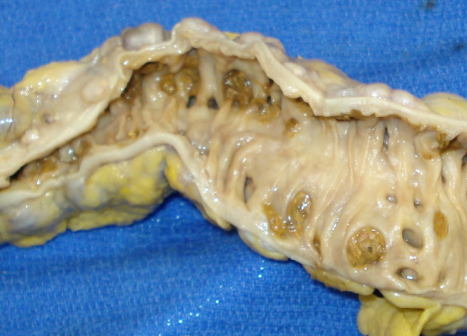 A 72-year-old woman comes to the office for follow-up of chronic abdominal pain.  She has had several episodes of left lower quadrant pain requiring hospitalization.  Despite treatment, her symptoms continue to recur.  Elective surgery is performed and a segment of resected and opened sigmoid colon is shown below.   Which of the following most likely contributed to this patient's condition? A) Consumption of high-fiber foods B) Frequent consumption of seeds and nuts C) High dietary intake of fat and red meat D) Infection with Helicobacter pylori E) Prolonged and excessive alcohol intake