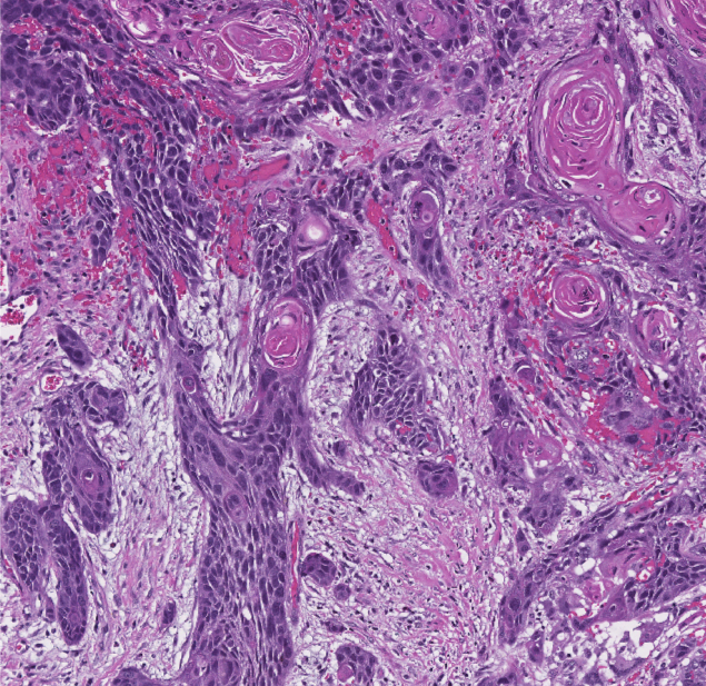 A 63-year-old man comes to the office due to several months of dysphagia, fatigue, occasional chest discomfort, and indigestion.  He has a history of hypertension and takes amlodipine.  The patient smokes 1 or 2 cigars daily.  His blood pressure is 140/80 mm Hg.  Physical examination is normal.  An endoscopic evaluation with esophageal biopsy is performed.  The histopathology of the specimen is shown in the image below.   Which of the following is the most likely cause of this patient's dysphagia? A) Benign tumor with slow growth B) Malignancy with probable poor prognosis C) Metaplasia with increased risk of adenocarcinoma D) Motor dysfunction with increased risk of carcinoma E) Reflux esophagitis with high risk of metaplasia