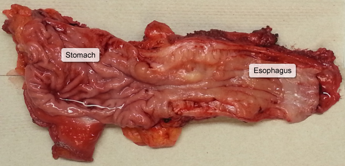 A 65-year-old man with a history of chronic gastroesophageal reflux comes to the clinic due to dysphagia.  The patient has had difficulty swallowing foods such as steak or hard-boiled eggs but is able to drink hot tea and coffee without any issues.  Increasing the frequency of his proton pump inhibitor to twice daily did not improve symptoms.  He has also lost 6.8 kg (15 lb)  over the past 4 months.  The patient has a history of hypertension, hyperlipidemia, and osteoarthritis.  Medications include amlodipine, atorvastatin, and ibuprofen as needed.  He drinks 2 or 3 glasses of wine with dinner most nights but does not use tobacco or illicit drugs.  Vital signs are within normal limits.  BMI is 32 kg/m<sup>2</sup>.  Physical examination is unremarkable.  Esophagogastroduodenoscopy reveals a 4-cm mass surrounded by a large segment of discolored mucosa in the lower half of the esophagus.  Esophagogastrectomy results are shown in the image below:   Which of the following is the most likely predisposing factor for this patient's esophageal disease? A) Alcohol use B) Chronic nonsteroidal anti-inflammatory drug use C) Helicobacter pylori infection D) Obesity E) Repeated thermal injury