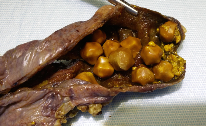 A 40-year-old woman comes to the office due to recurrent episodes of postprandial abdominal pain.  The pain is in the right upper quadrant and is associated with nausea.  The patient has no fever, jaundice, or loss of appetite.  Other medical conditions include obstructive sleep apnea and obesity.  The patient takes no medications.  She has never had any surgeries.  She does not use tobacco, alcohol, or illicit drugs.  The patient is afebrile.  Blood pressure is 140/90 mm Hg.  BMI is 38 kg/m<sup>2</sup>.  Examination shows tenderness in the right upper quadrant.  Abdominal ultrasound demonstrates multiple gallstones.  A gross specimen obtained from laparoscopic cholecystectomy is shown in the image below:   Which of the following is the most likely mechanism responsible for gallstone formation in this patient? A) Altered enterohepatic cycling of bilirubin B) Decreased bile acid synthesis C) Delayed gallbladder emptying D) Increased cholesterol synthesis E) Increased efflux of bilirubin into bile