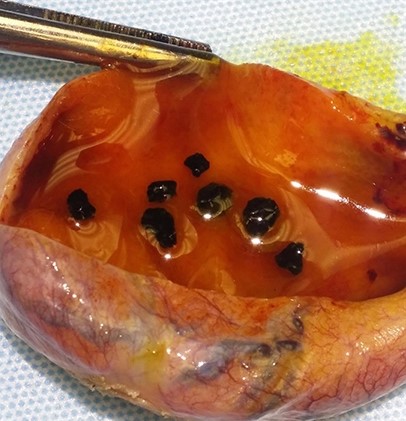 A 31-year-old woman comes to the emergency department due to worsening right upper quadrant pain, fever, nausea, and vomiting for a day.  The pain increases with deep inspiration.  Other medical conditions include uterine fibroids and sickle cell anemia.  The patient does not use tobacco, alcohol, or illicit drugs.  Temperature is 38.6 C (101.5 F) , blood pressure is 120/70 mm Hg, and pulse is 102/min.  BMI is 24 kg/m<sup>2</sup>.  On examination, the patient appears uncomfortable because of the pain; there is no jaundice.  Tenderness and guarding are present over the right upper quadrant.  Bowel sounds are decreased.  Hemoglobin is 10.1 g/dL and white blood cell count is 18,000/mm<sup>3</sup> with 7% band forms.  Abdominal ultrasound shows evidence of cholelithiasis and gallbladder wall thickening.  Gross inspection of the specimen obtained during laparoscopic cholecystectomy is shown in the image below:   Which of the following is most likely responsible for this patient's symptoms? A) Altered enterohepatic circulation of bilirubin B) Biliary stasis due to lack of enteral stimulation C) Decreased gallbladder motility due to denervation D) Impaired bile acid synthesis E) Increased cholesterol synthesis F) Increased efflux of bilirubin into bile