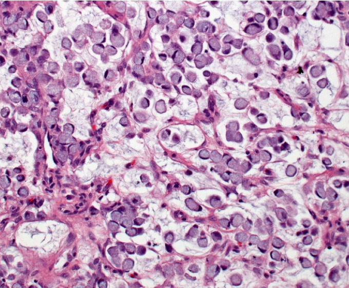 A 59-year-old man is evaluated in the clinic for recent unintentional weight loss.  He says,  My pants are fitting a lot looser than usual.   The patient also has epigastric discomfort after meals with occasional nausea.  He reports that food is not as appetizing as it used to be.  He has no known medical conditions and takes no medications.  The patient's father has a history of peptic ulcer disease.  Upper endoscopy shows a lesion in the stomach that is biopsied; a histologic section is shown below:   This patient's lesion is most likely to demonstrate which of the following gross findings? A) Deep ulceration and vessel erosion B) Infiltrative growth within the stomach wall C) Progressive mucosal atrophy D) Rapid intraluminal expansion E) Rugal thickening with acid hypersecretion