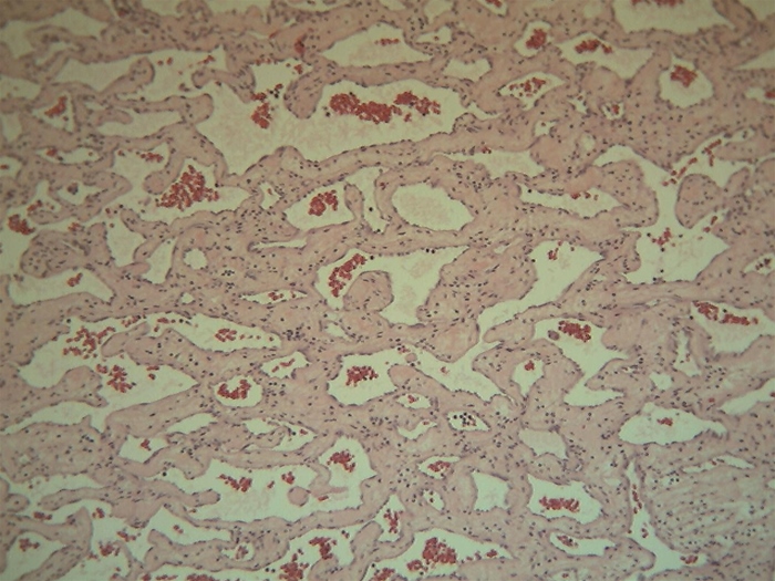 A mass resected from the liver of a 32-year-old woman has the morphology demonstrated on the slide below.   Which of the following is the most accurate statement concerning this patient's condition? A) Malignant transformation is a rule B) It is the most common benign liver tumor C) It can regress upon oral contraceptive discontinuation D) It is strongly associated with hemochromatosis E) Biopsy is indicated to confirm the diagnosis