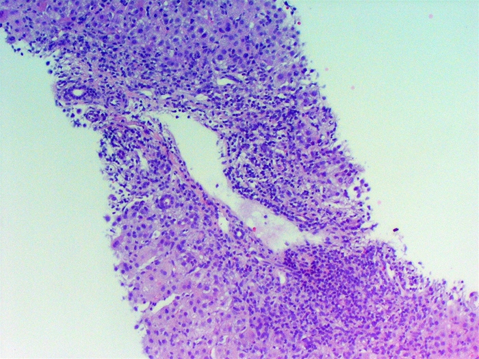 A 43-year-old man is evaluated in the hospital for a medical illness.  He has traveled to various countries on missionary trips and recently returned from South America.  The patient has no prior medical history and takes no medications.  His father has a history of alcohol dependence complicated by cirrhosis and portal hypertension.  A liver biopsy is performed, and light microscopy of the tissue demonstrates spotty hepatocyte necrosis and inflammatory cell infiltration, as shown in the image below.   Which of the following is the most likely initial clinical presentation of this patient? A) Clay-colored stools and osteoporosis B) Fever, anorexia, and dark-colored urine C) Prolonged pruritus and fatigue D) Skin pigmentation and diabetes mellitus E) Upper gastrointestinal bleeding and ascites
