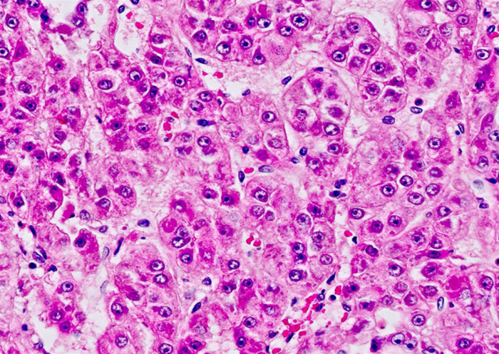 A 58-year-old man with a history of chronic liver disease secondary to hepatitis C infection comes to the office due to progressive fatigue and abdominal discomfort.  He has no other medical conditions, and a recent colonoscopy was normal.  Physical examination shows ascites and jaundice.  Ultrasonography of the abdomen reveals a solid mass within the liver parenchyma.  Surgical resection of the liver lesion is performed.  Microscopy reveals large cells with prominent nucleoli arranged in thickened plates as shown below.   Which of the following serum markers would be most useful for monitoring this patient for disease recurrence? A) 5-Hydroxyindoleacetic acid B) Alpha-fetoprotein C) CA 125 D) CA 19-9 E) Carcinoembryonic antigen F) Human chorionic gonadotropin