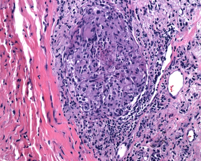 A 32-year-old man with abdominal pain and periodic diarrhea is found to have heme-positive stools.  Stool cultures show no growth of pathogenic organisms.  Colonoscopy with biopsy of the colonic mucosa is performed.  Light microscopy of the tissue sample is shown in the image below.   This patient most likely suffers from which of the following disorders? A) Acute appendicitis B) Collagenous colitis C) Crohn disease D) Ischemic colitis E) Pseudomembranous colitis F) Ulcerative colitis
