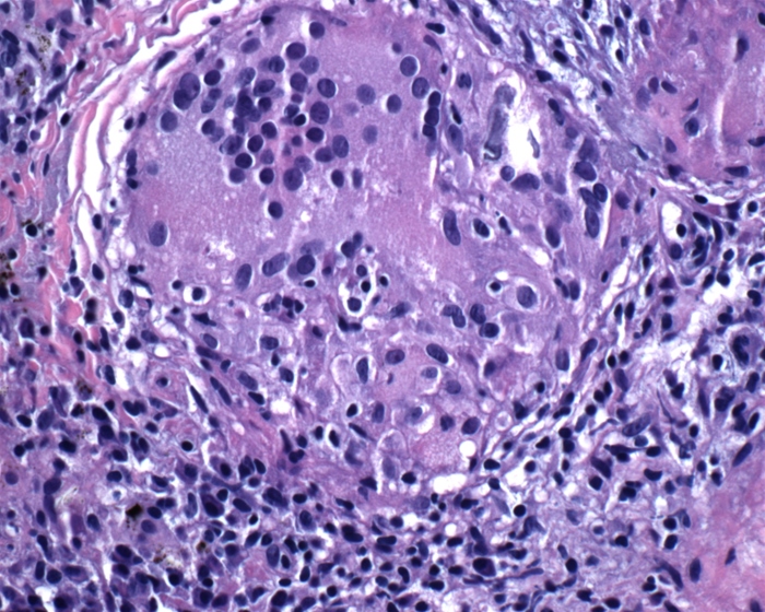 A 27-year-old woman undergoes laparotomy for right lower quadrant pain and is found to have an inflamed terminal ileum.  The involved segment of the intestine is removed, and the lesion observed on light microscopy is seen in the image.   Which of the following cell types most likely mediated the formation of this patient's lesion? A) B-lymphocytes B) Eosinophils C) Neutrophils D) Natural killer cells E) Th1 cells F) Th2 cells