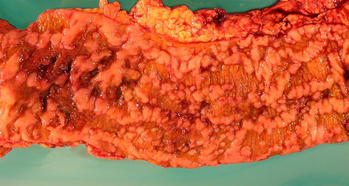 A 24-year-old woman comes to the office due to recurrent bloody diarrhea and right-sided abdominal pain.  She has had these symptoms intermittently for several years but has not sought medical attention until now.  Colonoscopy shows evidence of inflammation and dysplasia.  The patient is started on appropriate medical therapy but her symptoms fail to respond adequately.  She subsequently undergoes a colectomy of the involved region; findings are shown in the image.   The intestinal wall appears thickened.  Which of the following is the most likely diagnosis? A) Amoebic dysentery B) Collagenous microscopic colitis C) Crohn disease D) Graft-versus-host disease E) Pseudomembranous colitis F) Ulcerative colitis
