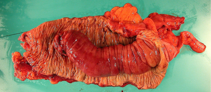 A 2-year-old Caucasian boy is hospitalized with abdominal pain and vomiting.  After initial evaluation laparotomy is performed, and a portion of the intestine is resected (see the slide below) .   This patient most likely suffers from: A) Mesenteric adenitis B) Acute appendicitis C) Pseudomembranous colitis D) Ischemic colitis E) Collagenous colitis F) Intussusception G) Meckel diverticulitis
