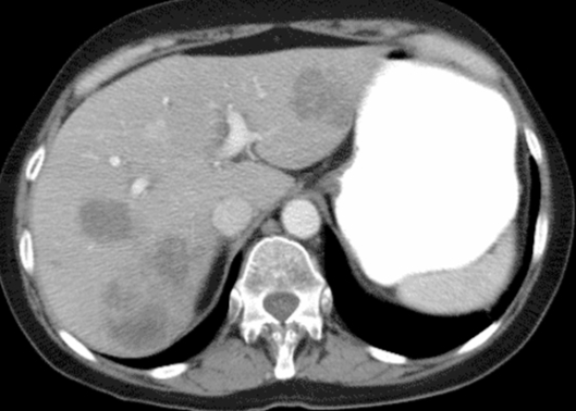 A 53-year-old man comes to the physician with progressively worsening anorexia and abdominal discomfort.  He has lost 14 kg (31 lb)  since the onset of his symptoms about 4 months ago.  Physical examination demonstrates nontender hepatomegaly.  Laboratory studies show an elevated serum alkaline phosphatase level and a marginally elevated alanine aminotransferase level.  A CT scan of the abdomen with oral and intravenous contrast is shown below.   Which of the following is the most likely diagnosis? A) Hepatic adenoma B) Hepatic angiosarcoma C) Hepatoblastoma D) Hepatocellular carcinoma E) Intrahepatic cholangiocarcinoma F) Metastatic liver disease