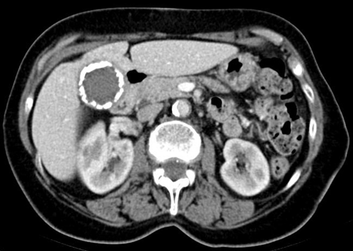 A 68-year-old woman comes to the office for a preventive visit.  The patient feels well, and recently lost 4 kg (8.8 lb)  on a new diet and exercise regimen.  She has no recent history of abdominal pain, jaundice, or changes in her stools.  Past medical history is notable for hypertension and hypercholesterolemia, for which the patient takes appropriate medications.  She does not use tobacco, alcohol, or illicit drugs.  Vital signs are normal.  On examination, the abdomen is soft and nontender, and no hepatosplenomegaly is noted.  However, a firm mass is palpated in the right upper quadrant.  CT scan of the abdomen is ordered and is shown below.   This patient is at elevated risk for which of the following conditions? A) Ascending cholangitis B) Cholangiocarcinoma C) Gallbladder adenocarcinoma D) Hepatocellular carcinoma E) Liver cirrhosis