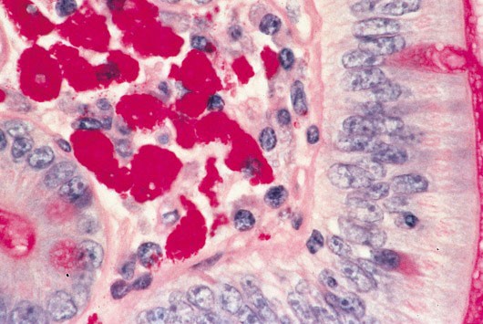 A 46-year-old man comes to the office due to abdominal discomfort and diarrhea.  The symptoms began 6 months ago, and he has now developed significant weight loss.  The patient does not use tobacco or alcohol.  Intestinal biopsy is performed, and a periodic acid-Schiff (PAS)  stained section is shown in the image below:   Which of the following is the most likely cause of this patient's symptoms? A) Chronic bacterial infection B) Immune-mediated gluten sensitivity C) Impaired lipoprotein formation D) Lactase deficiency E) Viral infection