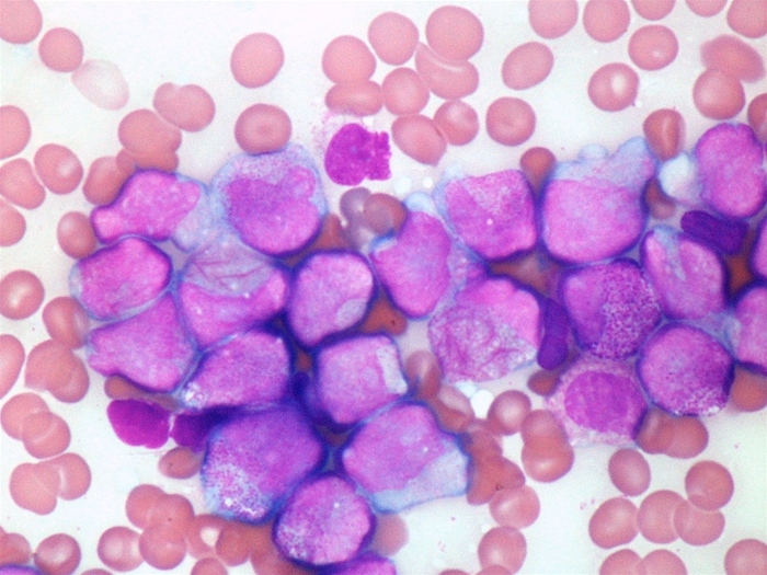 A 36-year-old man presents to your office with persistent fever, bleeding gums, and a sore throat.  Peripheral blood microscopy findings are shown in the image below.   These cells contain structures that would stain positive for which of the following? A) Major basic protein B) Myeloperoxidase C) Platelet-derived growth factor D) Tartrate resistant acid phosphatase E) Terminal deoxynucleotidyl transferase