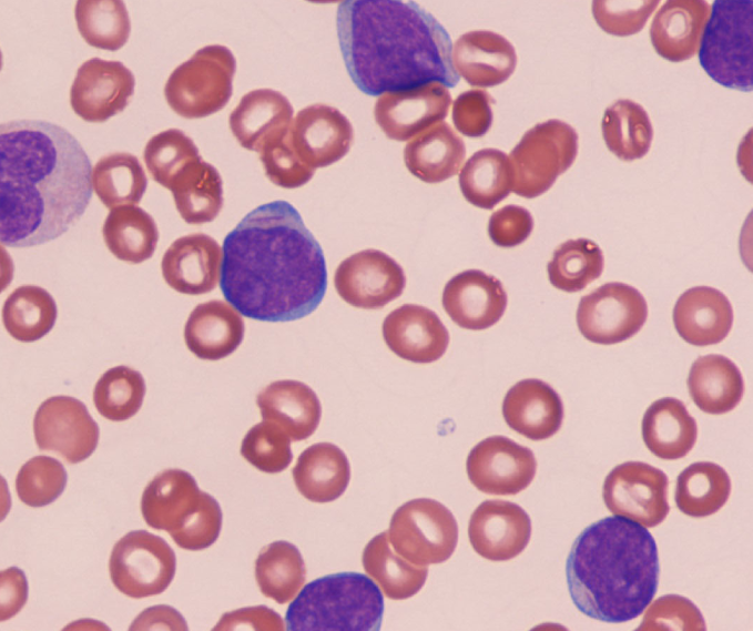 A 63-year-old man comes to the office due to fatigue and easy bruising.  He has no lymphadenopathy on physical examination.  Laboratory results are as follows:   The patient's peripheral blood smear is shown in the image below:   Which of the following is the most likely diagnosis? A) Acute lymphoblastic leukemia B) Acute myeloid leukemia C) Chronic lymphocytic leukemia D) Chronic myeloid leukemia E) Hairy cell leukemia F) Hodgkin lymphoma G) Infectious mononucleosis