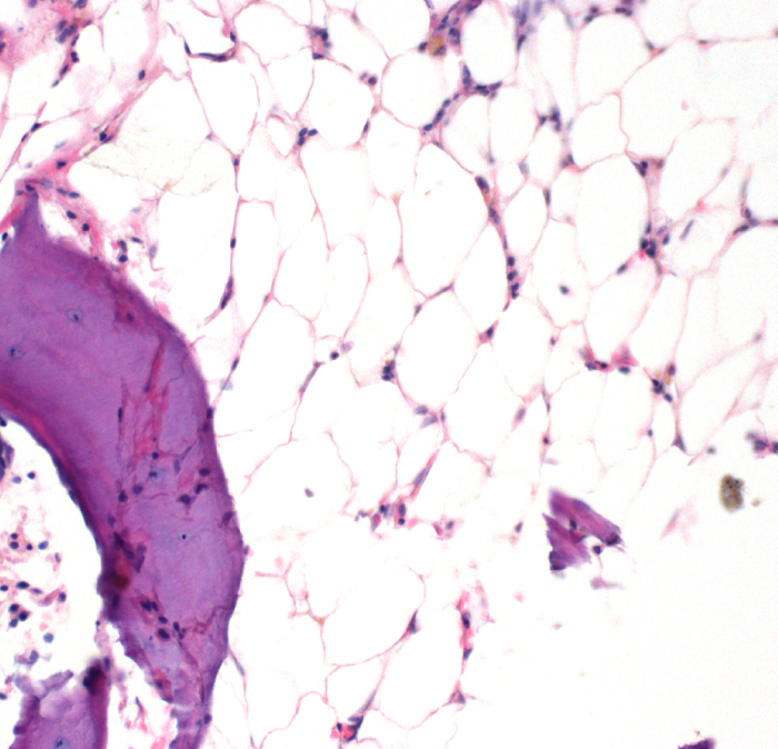 A 7-year-old boy is brought to the office due to easy bruising and frequent epistaxis for 2 weeks.  Temperature is 36.7 C (98 F) , blood pressure is 106/60 mm Hg, pulse is 94/min, and respirations are 18/min.  Examination shows pale lips with mucositis in the oropharynx.  The neck is supple.  The abdomen is soft, and pulses are 2+.  Laboratory results are as follows:   Findings from a bone marrow biopsy are shown in the image below:   Which of the following is the most likely diagnosis? A) Acute lymphoblastic leukemia B) Aplastic anemia C) Myelodysplastic syndrome D) Myelofibrosis E) Parvovirus B19 infection