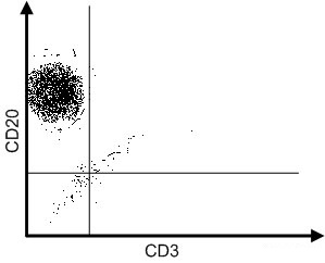 A 67-year-old woman is evaluated for worsening fatigue and exertional dyspnea.  She has no prior medical conditions and takes no medications.  The patient does not use tobacco, alcohol, or illicit drugs and consumes a balanced diet.  Vital signs are within normal limits.  Physical examination is notable for mucosal pallor.  Stool testing for occult blood is negative.  Laboratory studies reveal that hemoglobin is 6.7 g/dL, white blood cell count is 35,000/mm<sup>3</sup>, and platelets are 45,000/mm<sup>3</sup>.  Peripheral blood flow cytometry of the white blood cell population is shown below.   Which of the following is the most likely diagnosis? A) Adult T-cell leukemia B) Aplastic anemia C) Chronic lymphocytic leukemia D) Chronic myeloid leukemia E) Classic Hodgkin lymphoma