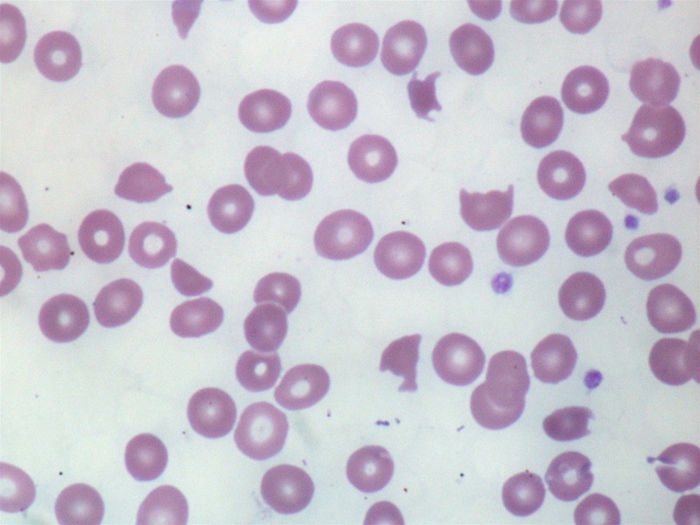 A 56-year-old man is evaluated for increased fatigability.  His past medical history is significant for diabetes mellitus, osteoarthritis, and severe aortic stenosis that required aortic valve replacement.  His peripheral blood smear is shown on the slide below.   Which of the following laboratory findings is most likely to be seen in this patient? A) Increased total serum iron level B) Decreased serum haptoglobin level C) Increased mean corpuscular volume D) Decreased reticulocyte count E) Decreased serum albumin level
