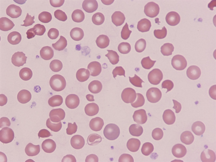A 7-year-old boy comes to the office for follow-up.  A week ago, the patient began having episodes of bloody diarrhea that have since resolved.  His current laboratory studies show elevated blood urea nitrogen and serum creatinine levels.  Complete blood count reveals anemia and thrombocytopenia.  Coagulation studies are within normal limits.  His peripheral blood smear is shown in the image below.   Which of the following is the most likely cause of this patient's anemia? A) Autoimmune hemolytic anemia B) Erythropoietin deficiency C) Hemolytic anemia due to oxidative stress D) Bone marrow fibrosis E) Microangiopathic hemolytic anemia