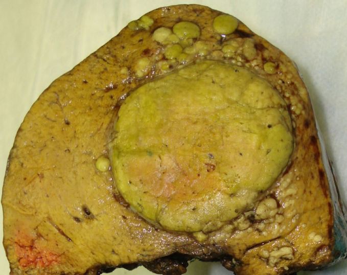 A 64-year-old man is brought to the hospital by ambulance after being found unresponsive by his brother.  Despite resuscitative efforts, he dies shortly thereafter.  The family reports that the patient had 2 months of progressive fatigue and an unintentional weight loss prior to the episode.  Autopsy examination reveals a massive pulmonary embolus, and a cross-section of the liver shows the following:   Genomic analysis of the hepatic lesions demonstrates intranuclear fragments of foreign DNA.  These fragments most likely belong to which of the following pathogens? A) Cytomegalovirus B) Entamoeba histolytica C) Epstein-Barr virus D) Hepatitis B virus E) Hepatitis C virus F) Human papilloma virus