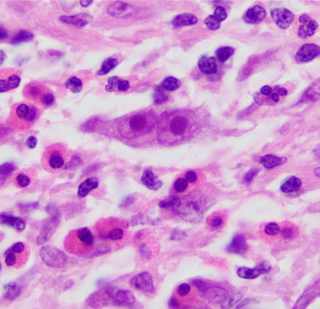 A 28-year-old previously healthy man comes to the office due to episodic fevers, night sweats, and weight loss for several months.  He emigrated from Kenya with his family at age 14.  He does not use tobacco, alcohol, or illicit drugs.  The patient works as a driving instructor and volunteers at a homeless shelter.  His temperature is 37.2 C (99 F) .  Physical examination is normal with the exception of cervical lymphadenopathy.  A lymph node biopsy is performed, and histopathologic findings are shown in the image below.   Which of the following is the most likely diagnosis? A) Burkitt lymphoma B) Follicular lymphoma C) Hodgkin lymphoma D) Large B-cell lymphoma E) Multiple myeloma F) Tuberculosis